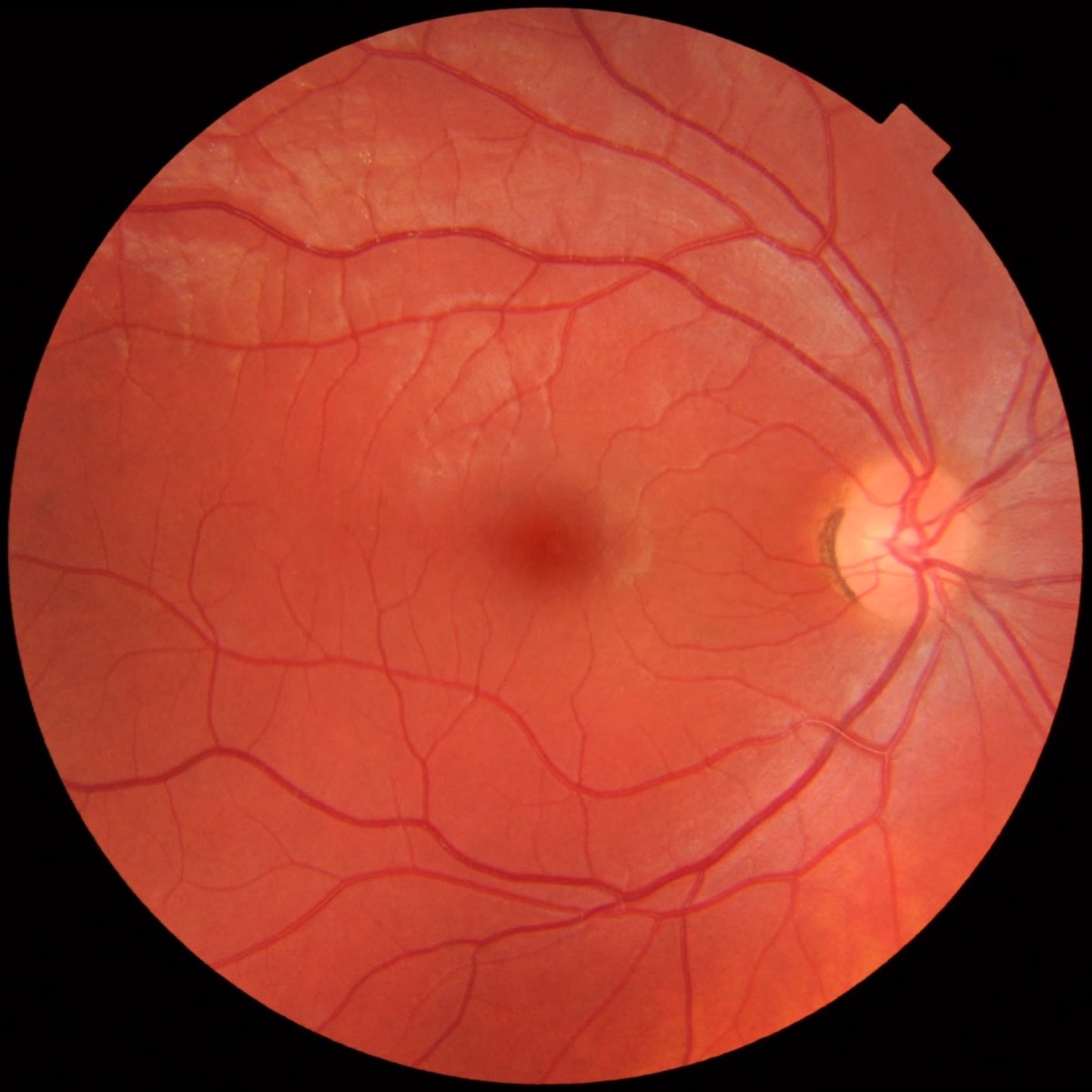 A color fundus photograph of a healthy human retina and optic nerve head, illustrating the eye - the first target of Life Biosciences' ER-100 cellular reprogramming therapy