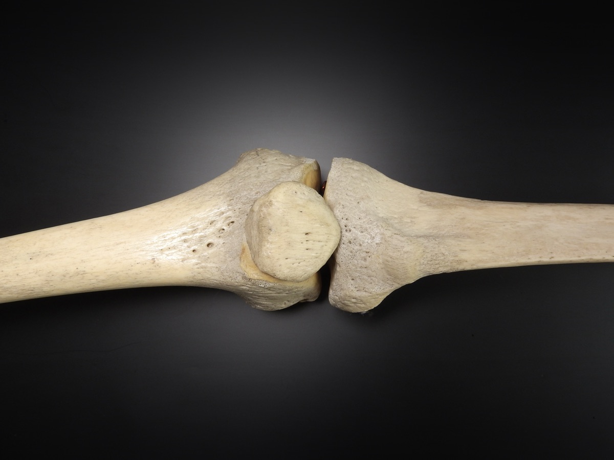Anatomical photograph of a human knee joint, illustrating a Stanford study showing that blocking the aging enzyme 15-PGDH regrew joint cartilage